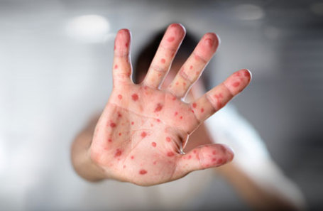 https://cdn.bfm.ru/news/maindocumentphoto/2019/02/06/measles.jpg